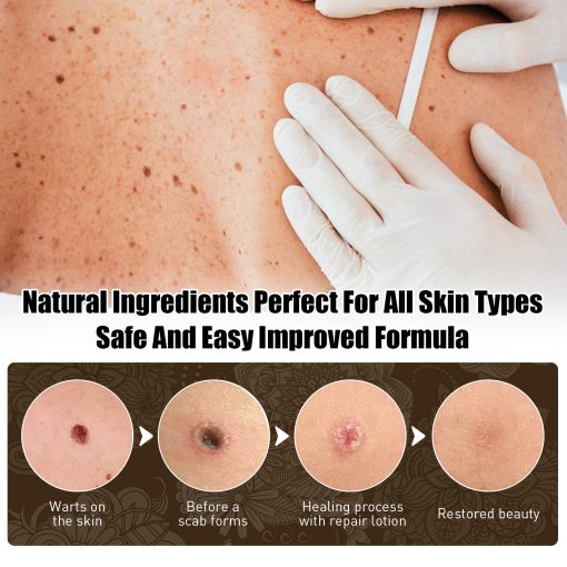 Skin Cleansing Black Mole Wart Skin care lotion Hand And Foot Face Armpit Flesh Bump Neck Care Cream - Image 6